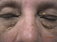 Eyelid Xanthelasma Removal